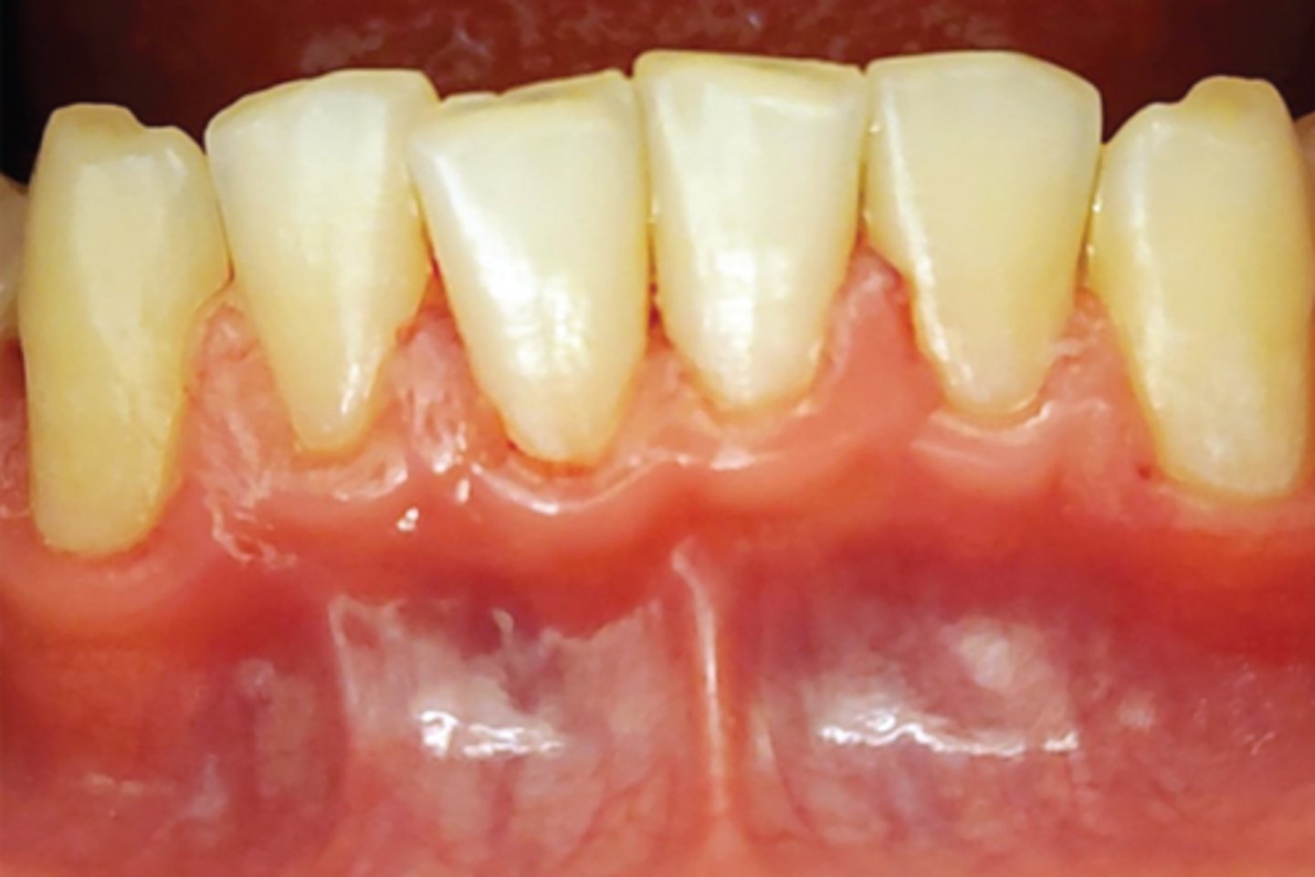 <p>Describe this tissue type</p><p>• there is lack of k____ t_____</p><p>• v___ t_____ k_______</p><p>• biotype: t____ s______</p>