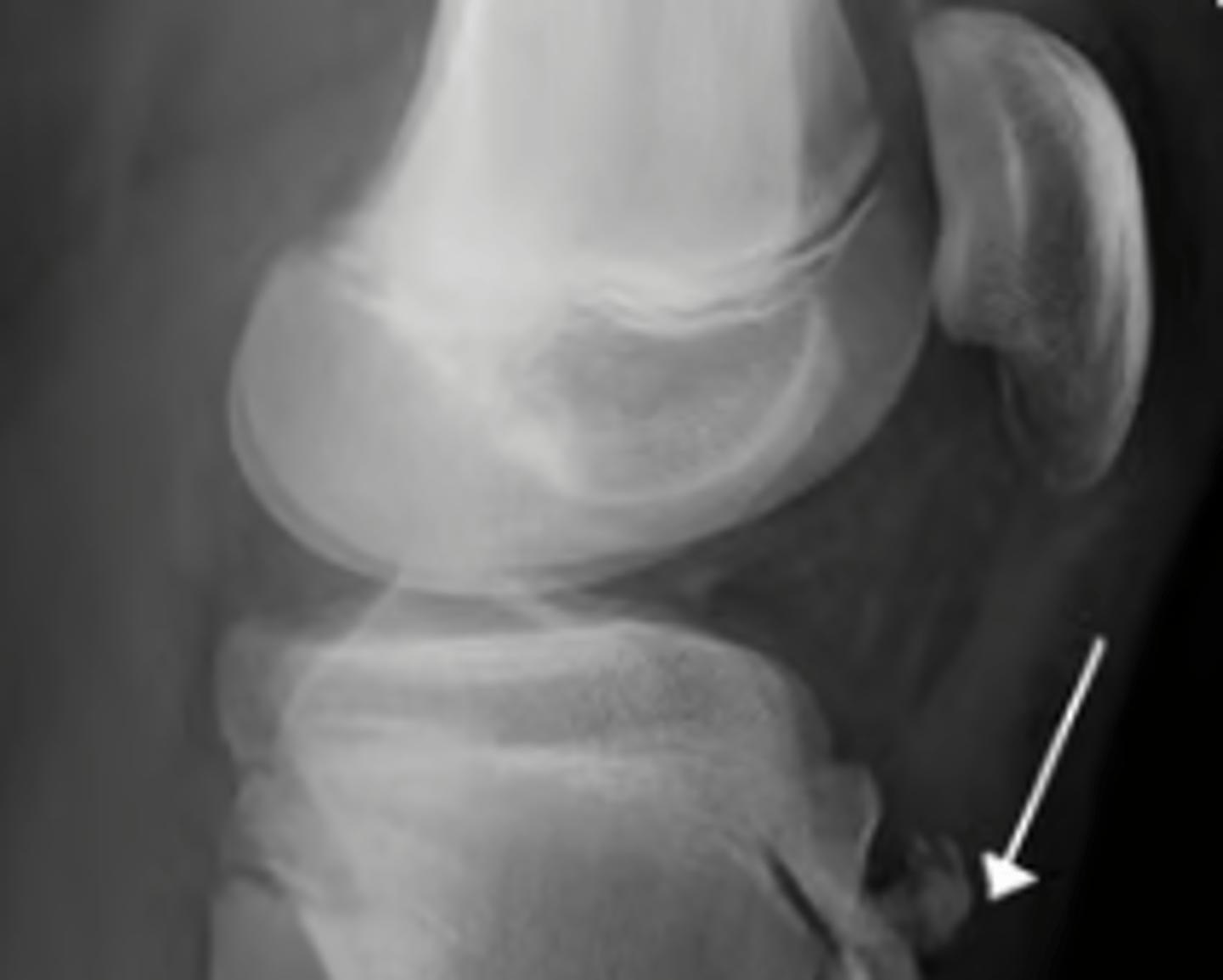 <p>Osgood Schlatter → RICE, NSAIDS, ortho consult</p><p>but r/o fx on plain film XR</p>