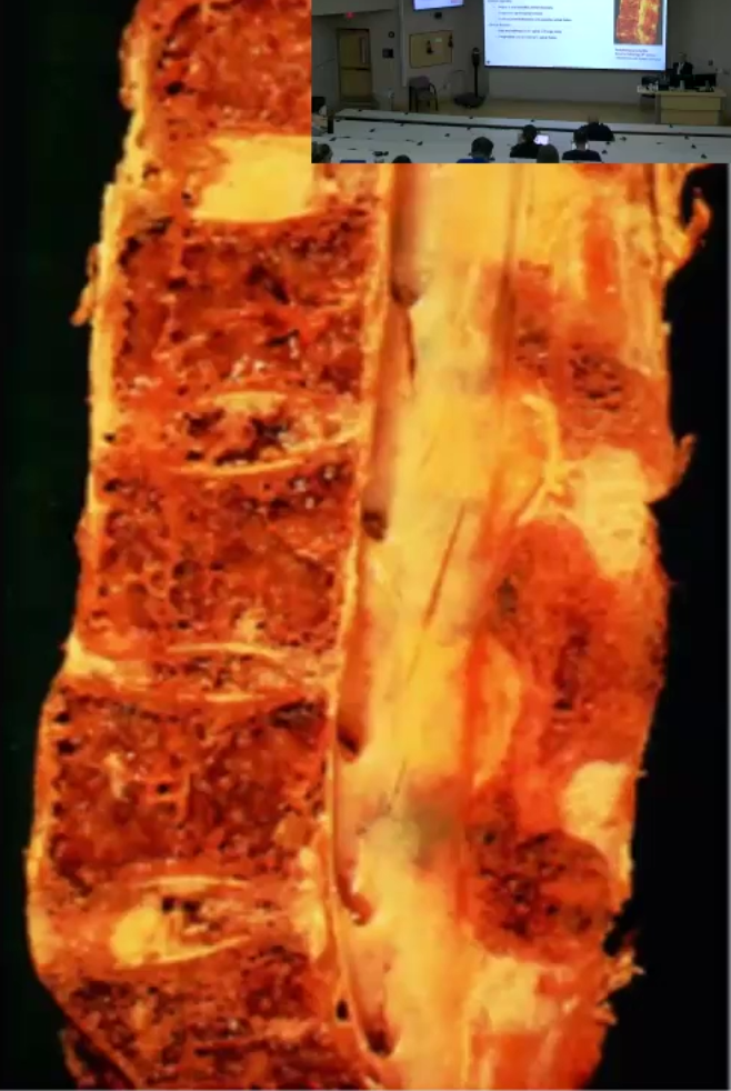 <ul><li><p>Autoimmune disease affecting the vertebral column and sacroiliac joints</p></li><li><p>Associated with <strong>HLA-B27</strong> antigen</p></li><li><p>Clinical Features: Pain and stiffness in the spine and large joints, leads to spinal fusion</p></li></ul><p></p>