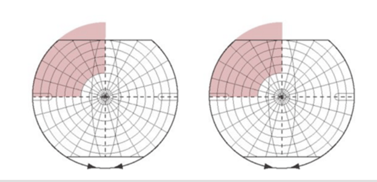 <p>Contralateral (L) superior quadrantanopia</p>