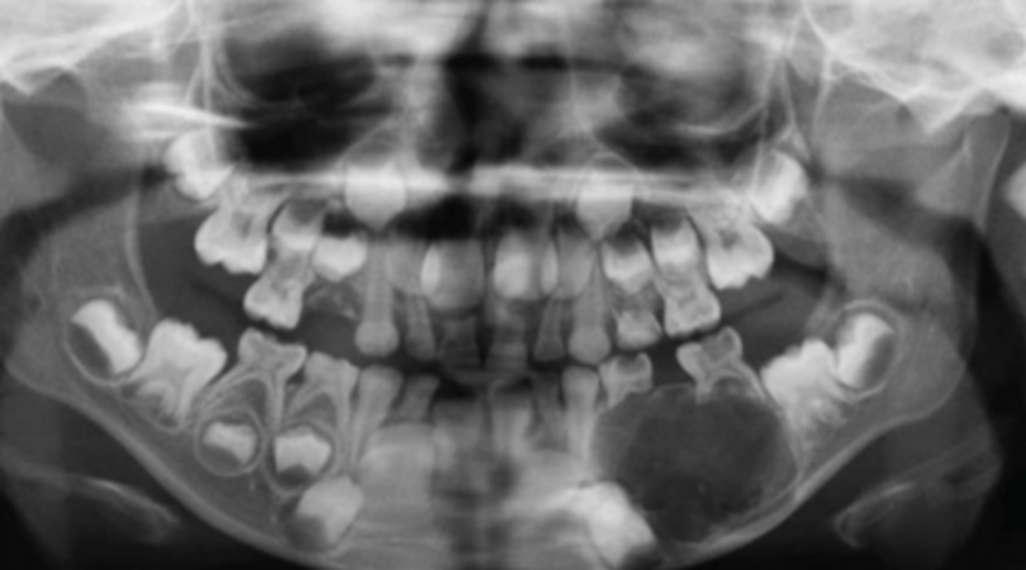 <p>mostly in younger patients</p><p>posterior mandible is affected mostly</p><p>associated with unerupted tooth</p><p>xray- small and unilocular OR large and multilocular</p>
