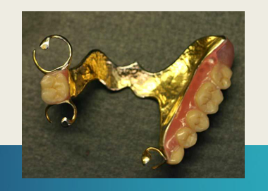 <p>Adv:</p><ul><li><p>Low melting point</p></li><li><p>Easy to cast</p></li><li><p>easy to solder</p></li><li><p>can be heat hardened (order hardened)</p></li><li><p>easy to finish/polish</p></li><li><p>biocompatible</p></li><li><p>corrosion resistant</p></li></ul><p>dis:</p><ul><li><p>High density</p></li><li><p>Low yield stress</p></li><li><p>low modulus&nbsp;</p></li><li><p>expensive</p></li></ul><p></p><p>high density and low modulus - needs to be in thick cross sections - not comfortable for patient&nbsp;&nbsp;</p>