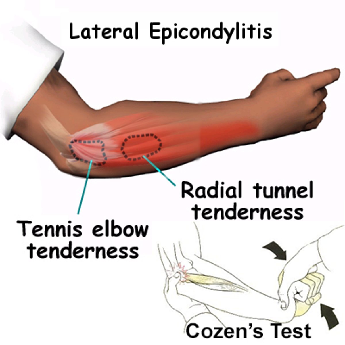 <p>pain in the lateral epicondyle with:</p><p>- forearm pronation</p><p>- wrist extension &amp; radial deviation</p>