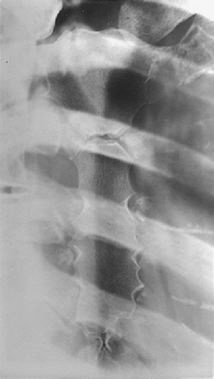 <p>Places sternum over heart shadow, reducing lung/rib superimposition.</p>