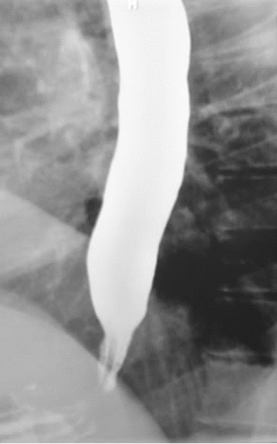 <p>BA esophogram → <strong>“birds beak tapering”  of esophagus; </strong>dilation (late finding)</p><p>endoscopy to r/o neoplasm</p><p>confirm w/ manometry</p>