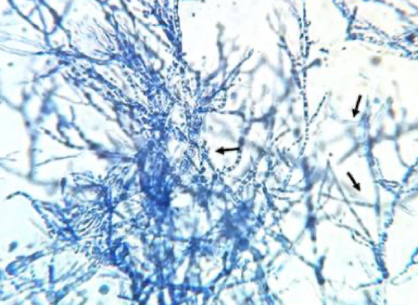 <p><strong>Diagnosis:</strong> wet mount showing hyphae, serologic antibody tests, or PCR. </p><p><strong>Treatment:</strong> complete surgical excision when possible, plus immunotherapy. Prognosis depends on lesion extent.</p>