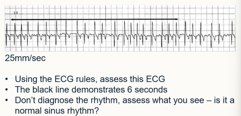 <p>Using ECG rules, assess this ECG</p><ul><li><p>the black line = 6s</p></li><li><p>assess what you can see</p></li><li><p>is it normal sinus rhythm</p></li></ul><p></p>