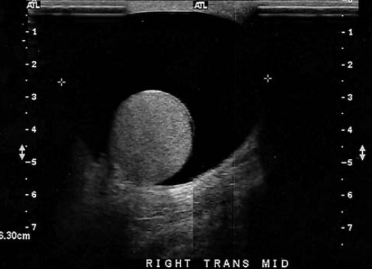 <p>a 70-year old man presents with history of scrotal enlargement. He denies trauma to the scrotum or groin areas. On the basis of this clinical history, the sonographic findings are most sus for</p>