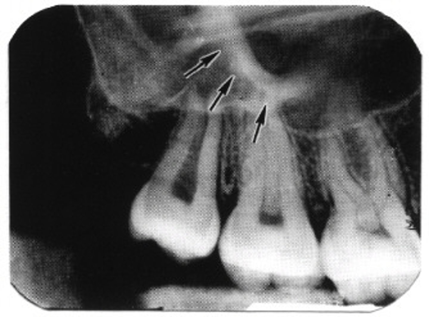 <p>apices of max molars</p>
