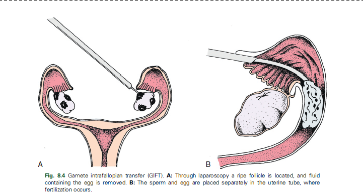 <p>Oocytes are retrieved from the ovary, placed in a catheter with washed motile sperm, and immediately transferred into the fimbriated end of the uterine tube. Fertilization occurs in the uterine tube.</p><p><span style="color: yellow"><strong>There must be normal tubal anatomy, patency, and absence of previous tubal disease in at least one uterine tube</strong></span></p>