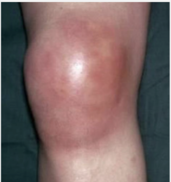 <p>Patient presents to the ER for knee pain. The knee is swollen, bright red, warm and tender to the touch. The patient was brought in in a wheelchair as it is SO painful to walk and the patient cannot tolerate passive range of motion. What diagnostics you want?</p>