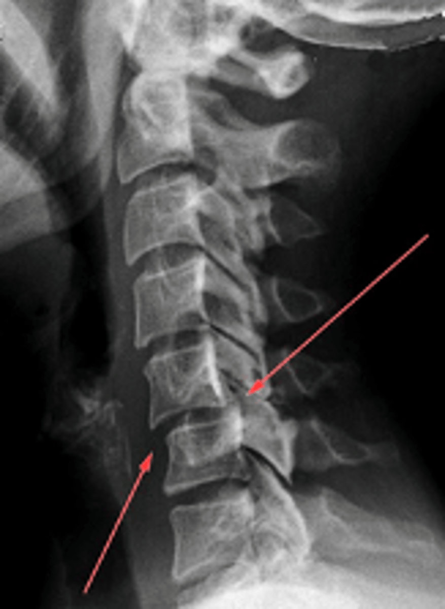 <p>a partial dislocation of a joint; common in the vertebral column</p>