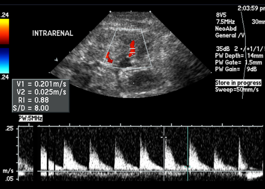 <p>Considering the RI on this image, which is most likely the diagnosis? </p>