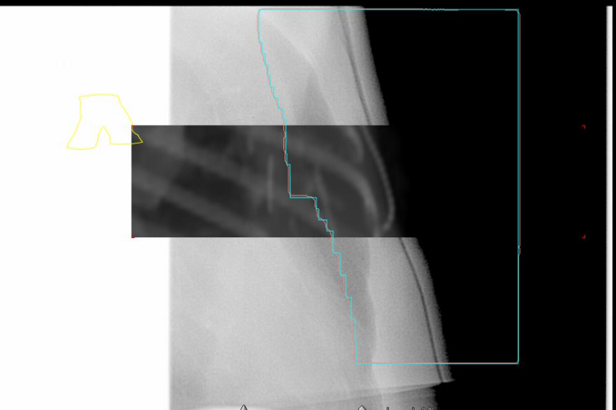 <p>when doing our medial BEV check for a chest wall patient? what are two things we are looking for</p>