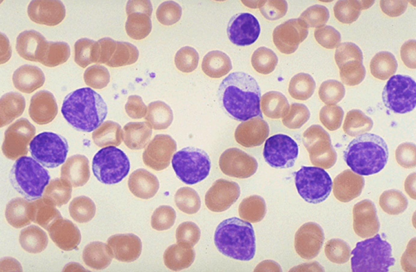 <p><span>What type of leukemia is this? Acute or Chronic</span></p>