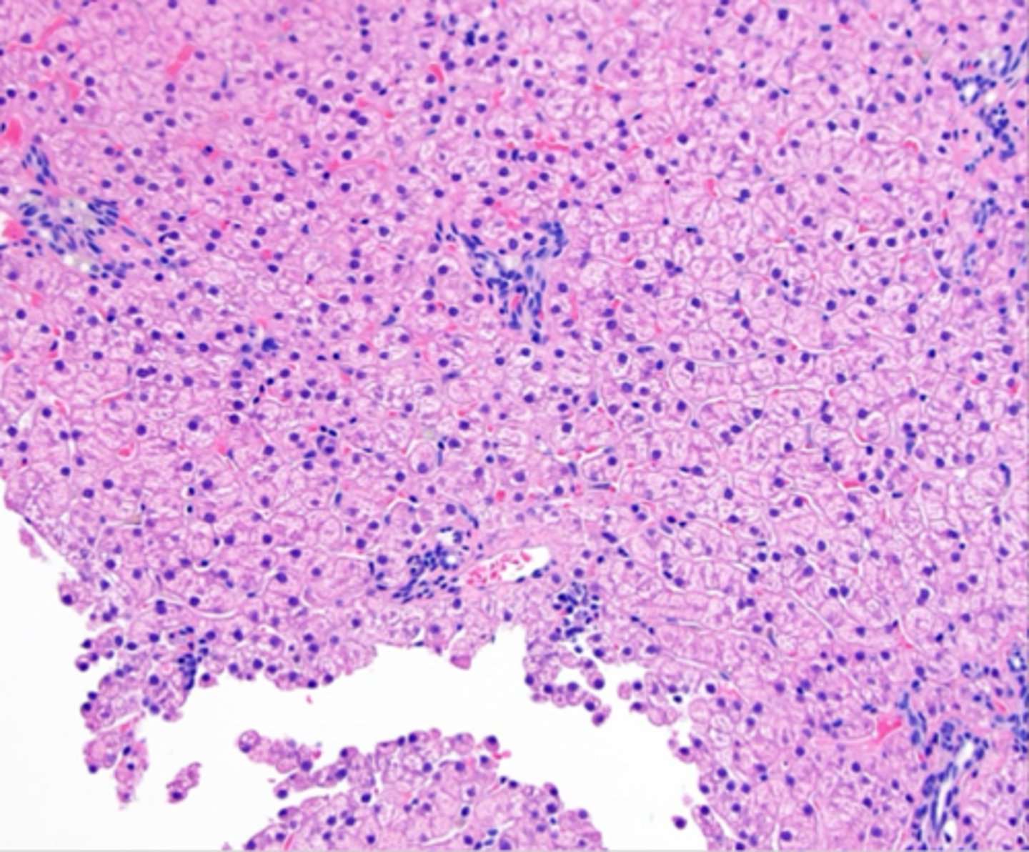 <p>Primary portal vein hypoplasia</p>