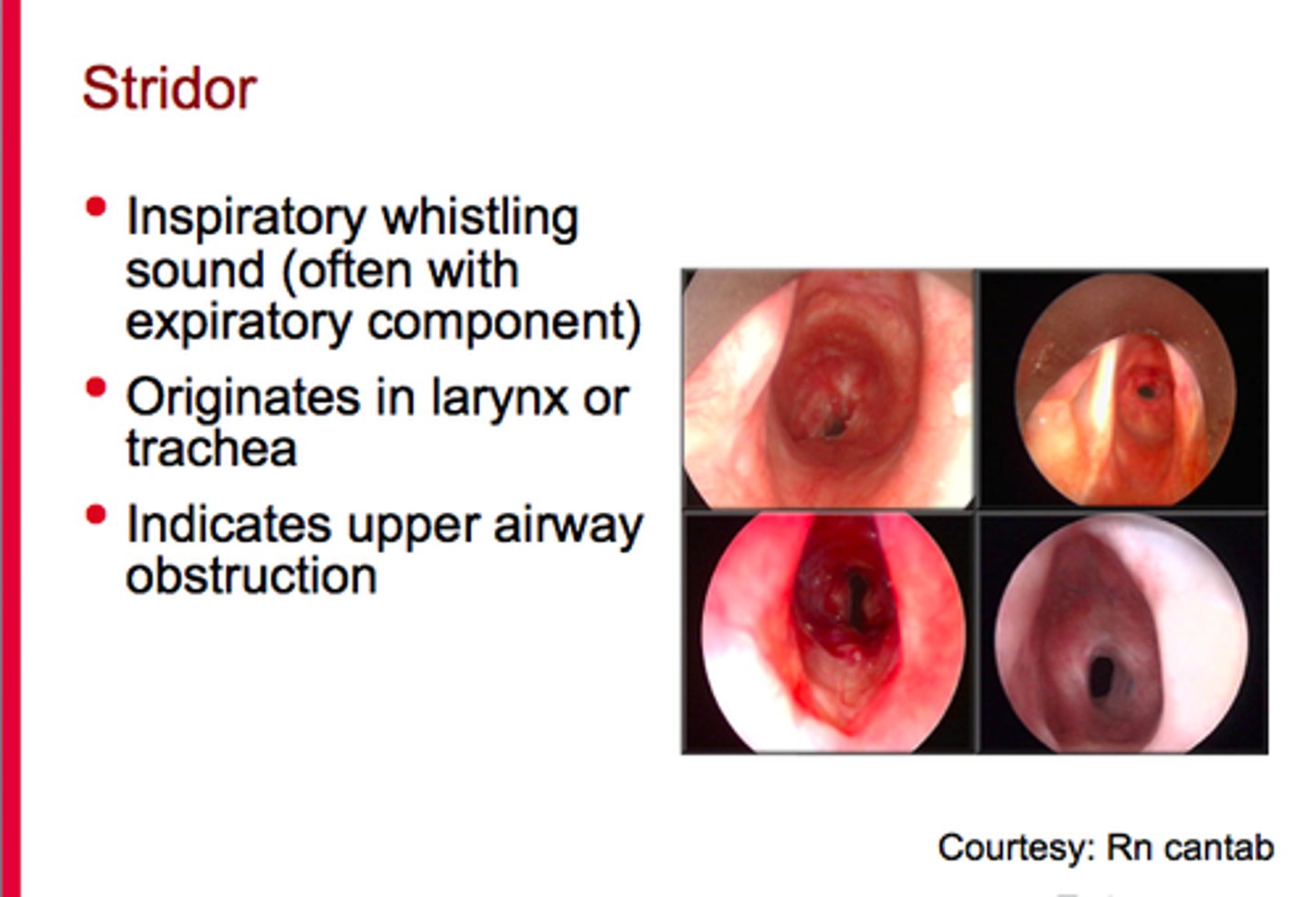 <p>Occurance: Inspiration</p><p>Quality: Loud, high-pitched crowing heard without a stethoscope</p><p>Causes: Obstructed upper airway (anaphylaxis)</p>