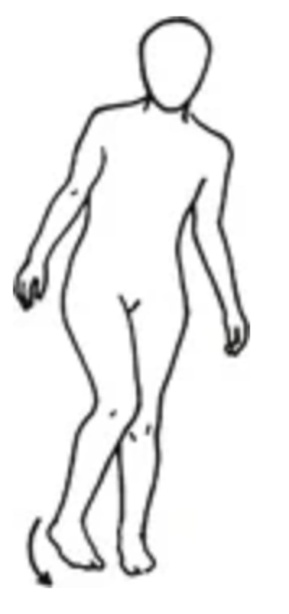 <p>- An abnormal gait in which the person's knees cross or are in contact, like holding an orange between the thighs</p><p>- Can be caused by MS</p>