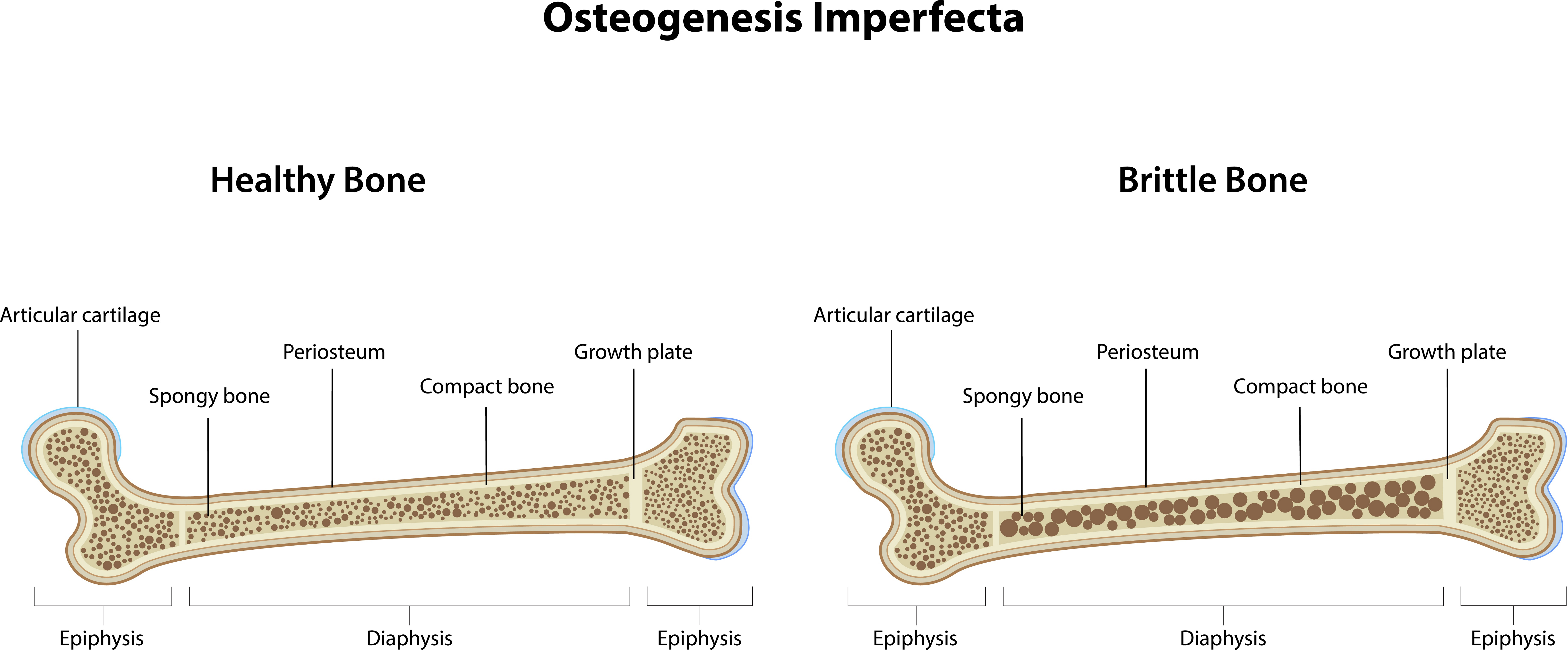 <p>genetic and congenital condition that involves defective development of connective tissue, resulting in deformed and abnormally brittle bones that are easily fractured</p>