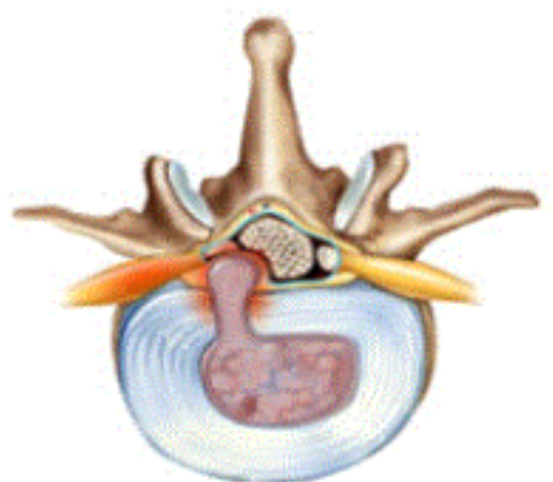 <p>weakness/ rupture of annulus fibrosis so nucleus pulposis bulges out and presses against spinal nerve </p>
