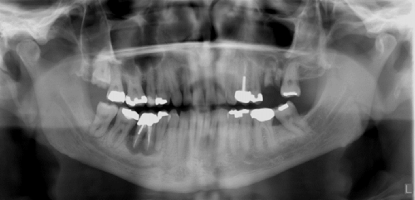 <p>Sequel of an acute episode</p>