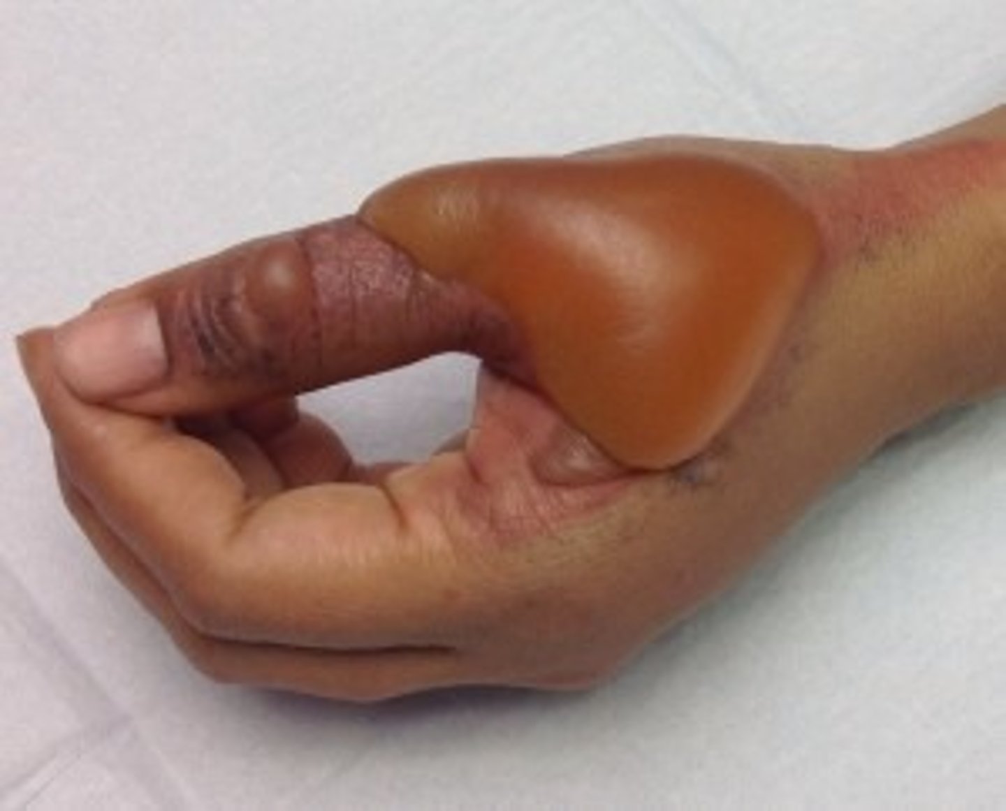 <p>- red, wet, skin</p><p>- open and closed blisters</p><p>- skin spotted and blotchy</p><p>- area is painful</p><p>- area is swollen</p><p>- area is deep</p>