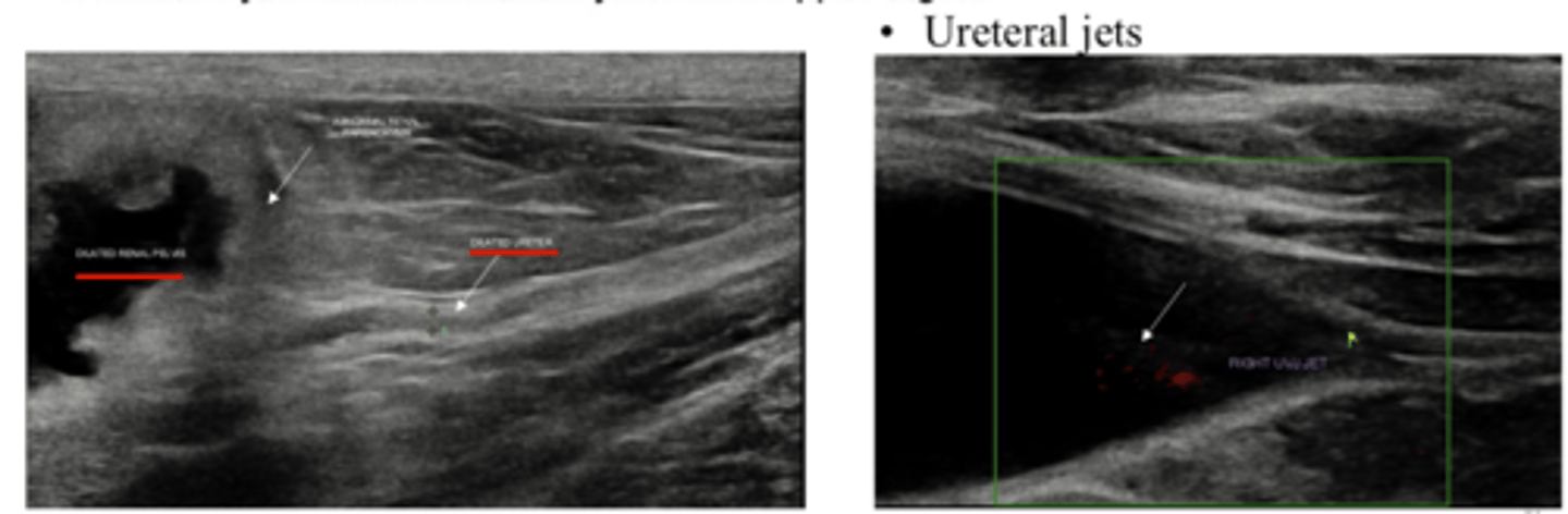 <p>Not always visible</p><p>Ureteral jets at uterovesical junction (Doppler) shows urine movement</p><p>Need to assess if renal pelvis is distended</p>