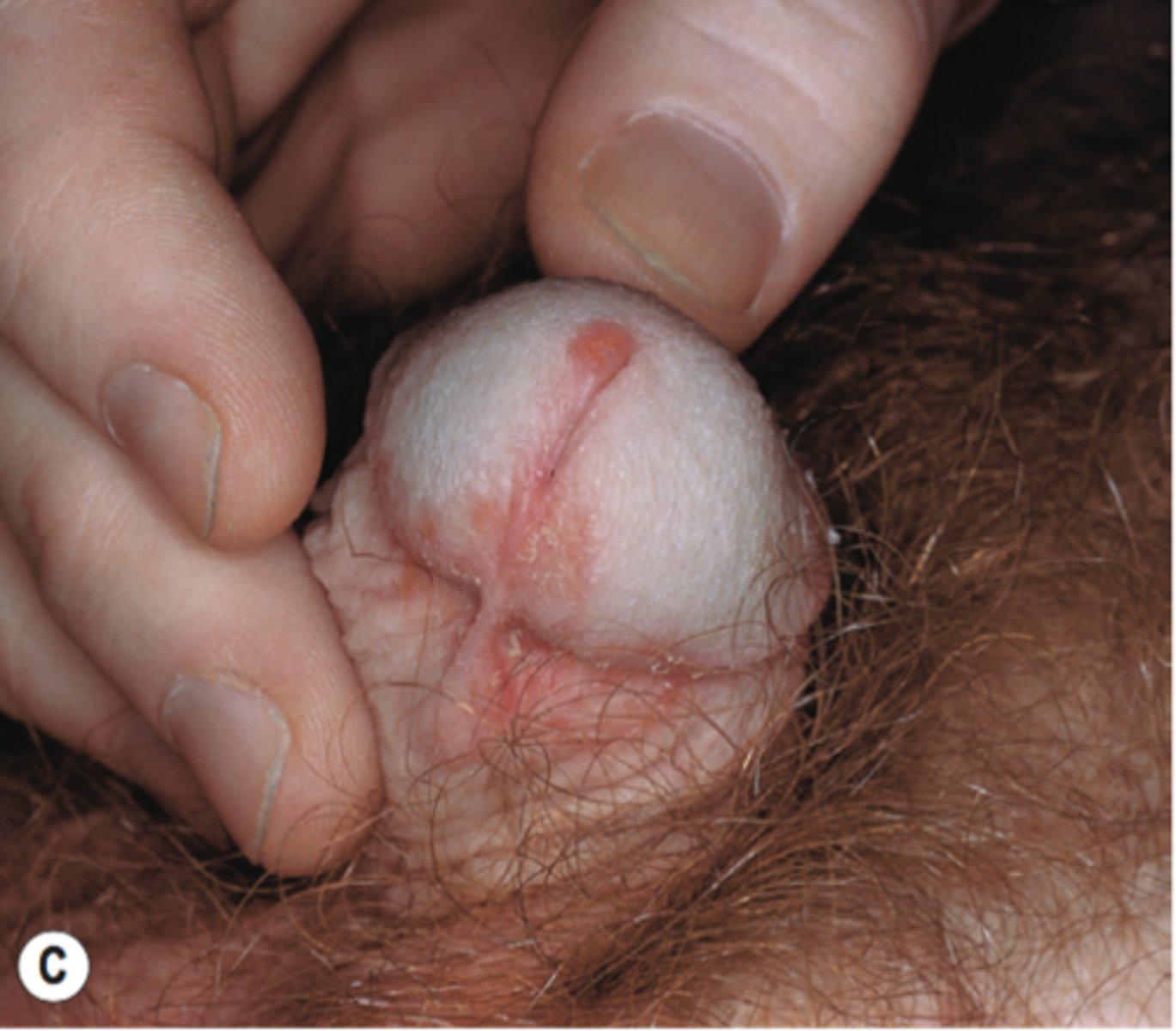 <p>Welke ziekte duidt de volgende definitie aan: ... is een verzamelnaam voor erythemateuze, al of niet erosieve inflammatoire laesies van het slijmvlies van de glans penis.</p>