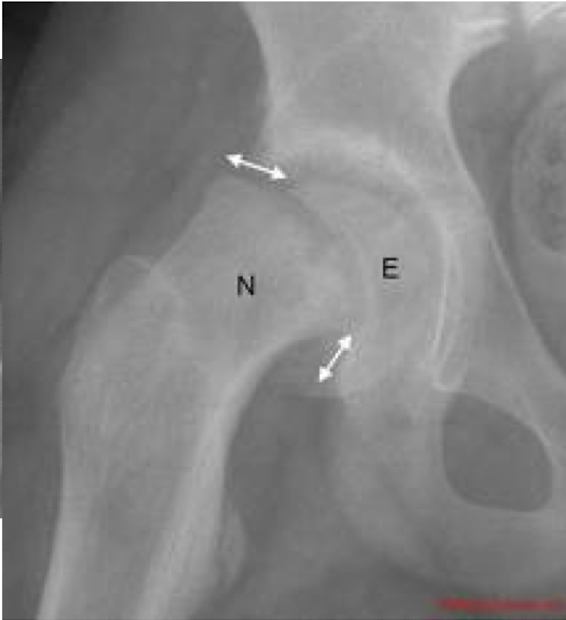 <p>Hip: Slipped Femoral Capital Epiphysis</p><ul><li><p>MC Pop:</p></li><li><p>Occurs where?</p></li><li><p>What does the pt complain of? (3)</p></li></ul><p></p>