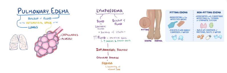 <p>types of oedema</p>