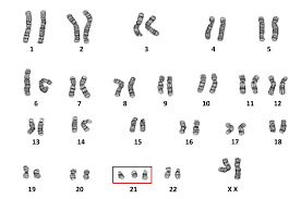 <p>Trisomy 21</p>