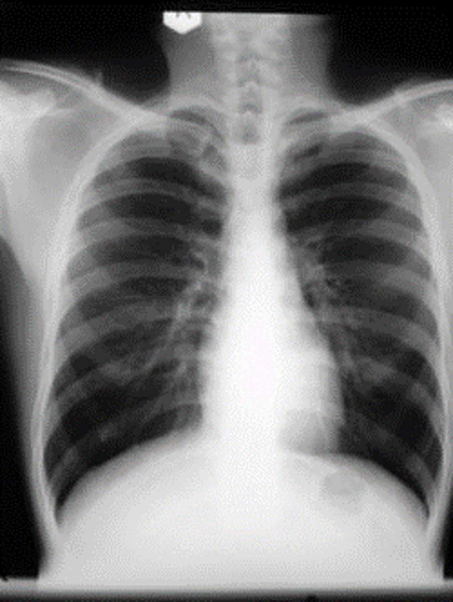 <p>bronchitis</p>