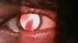 <p>When can the scissors reflex be seen?</p>