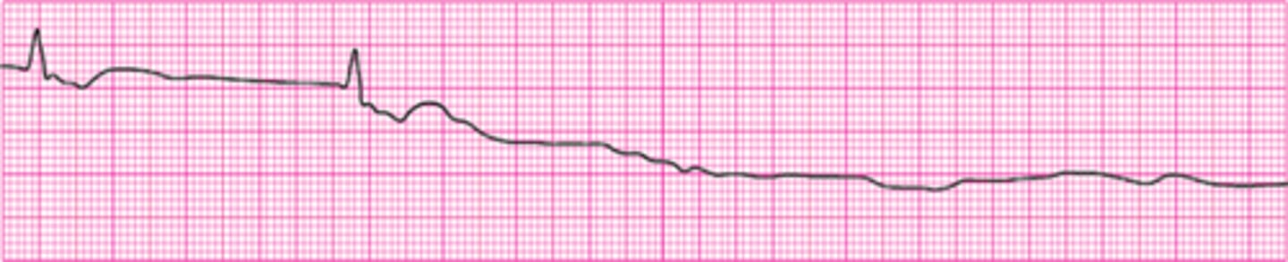 <p>Agonal Rhythm/Asystole</p>
