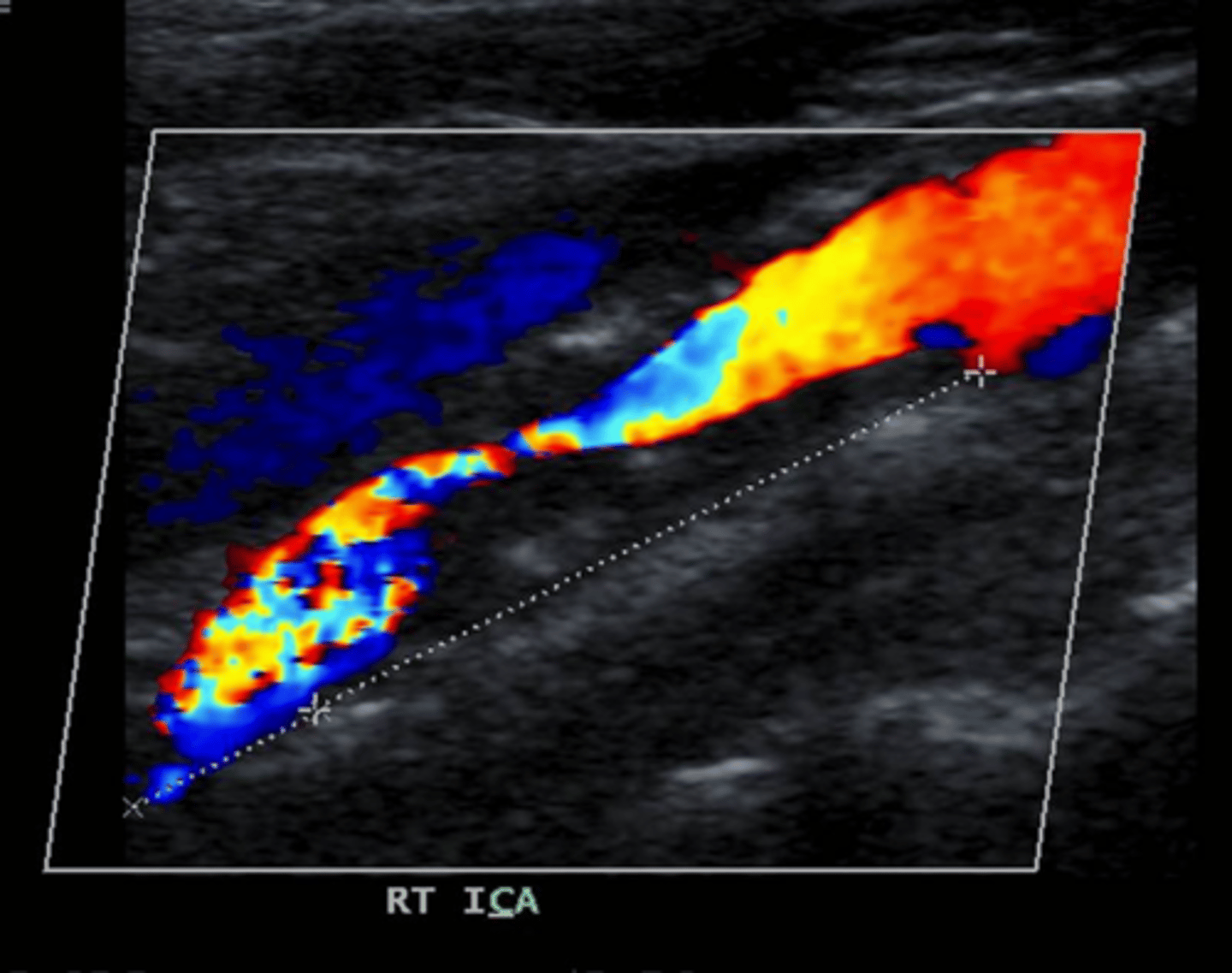 <p>This occurs in nearly occluded vessels and involves very low velocities.</p>
