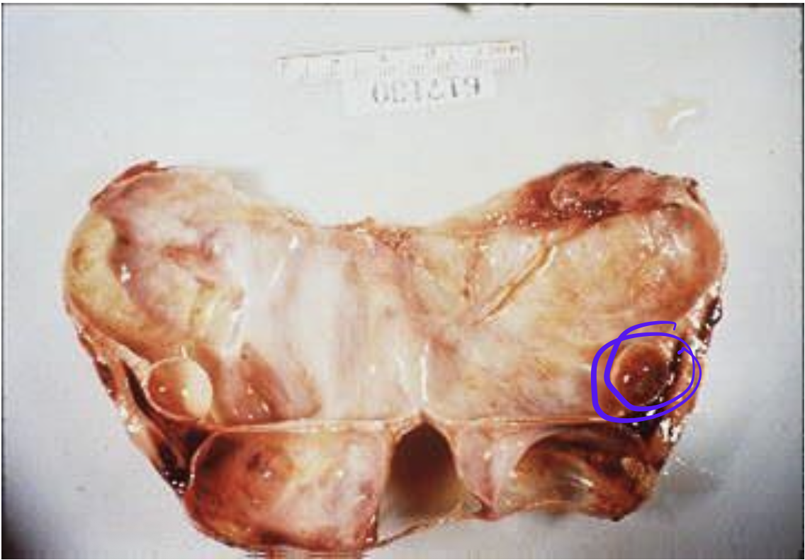 <p>Identify the <strong>organ</strong> and the <strong>diagnosis</strong> in this format: <em>diagnosis, organ</em></p>