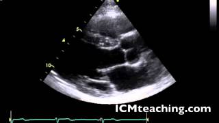 Where is the descending aorta in this picture?