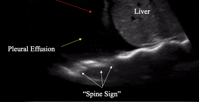 <p>What is the spine sign?</p>