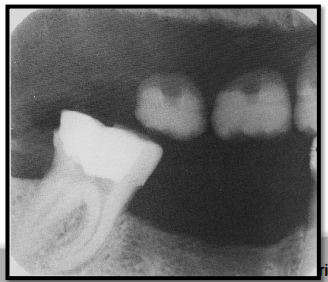 <p>looks like rootless or floating teeth. </p>