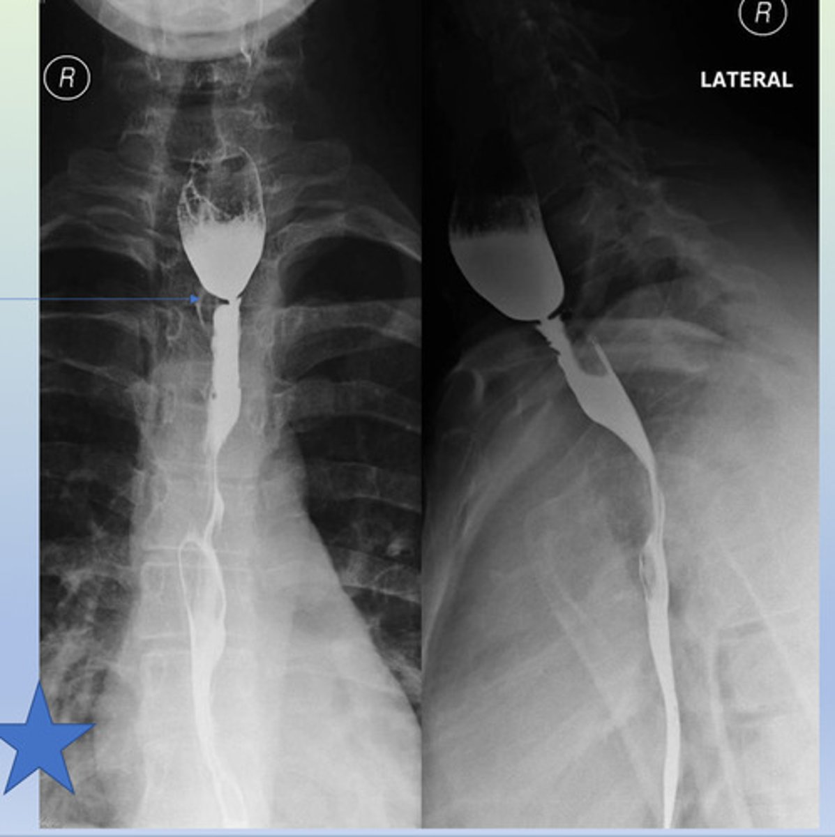 <p>radiolucent ring in the upper esophagus; occurs in the cervical esophagus near cricopharyngeus muscle; arise from the anterior wall &amp; never from the posterior; Dx TOC: barium swallow</p>