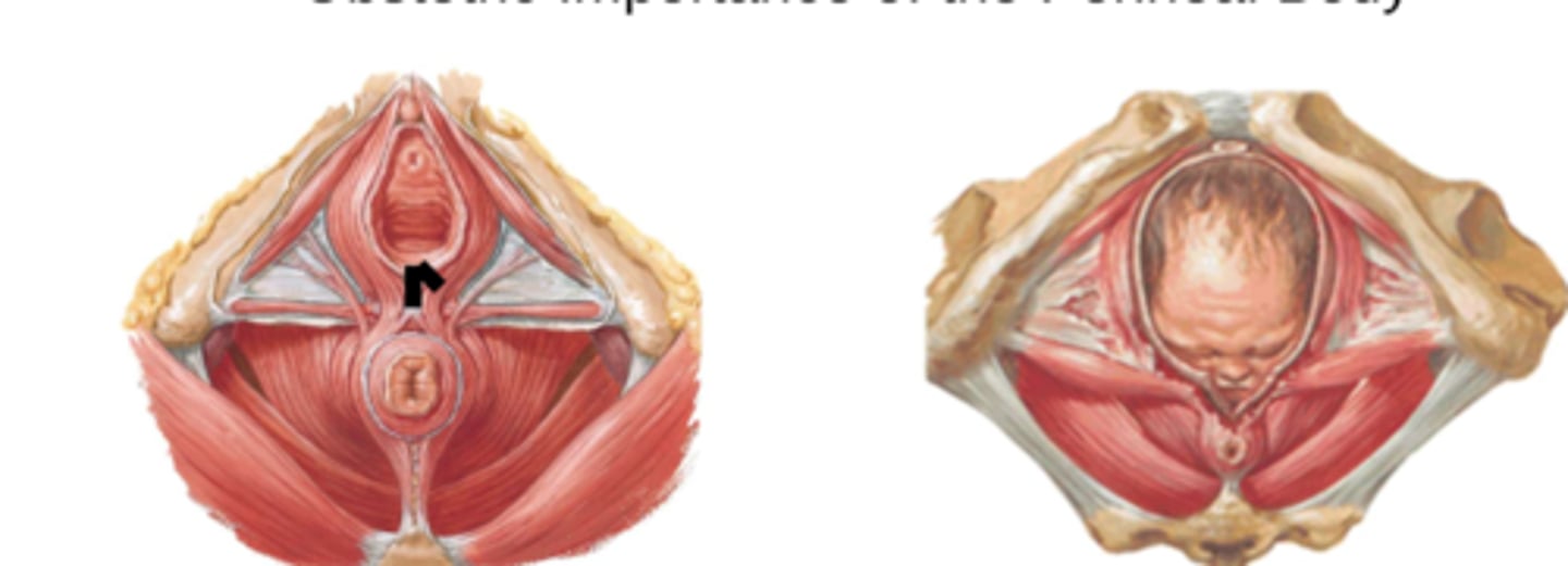 <p>surgical incision that guides location and tear during birth</p>