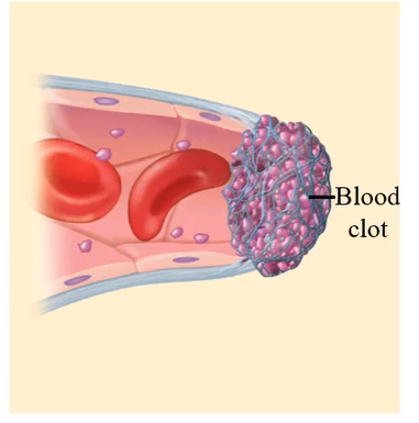 <p>If the bleeding does not stop after the formation of the white thrombus, blood clotting enzymes are activated to form a stronger gel-like clot at the cut site.</p>