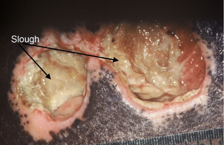 <p>Soft, moist avascular tissue that adheres to the wound end in strings or thick clumps; may be white, yellow, tan, or green</p>
