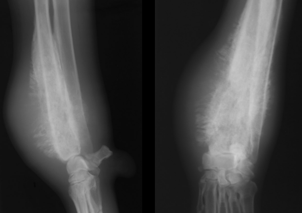 <ul><li><p><strong>Cause</strong></p><ul><li><p>Lesion usually <strong>solitary in long bones</strong></p></li><li><p><strong>Osteosacrcoma #1</strong></p></li></ul></li><li><p><strong>Signalment</strong></p><ul><li><p><strong>Lg mid age male </strong>dogs</p></li></ul></li><li><p><strong>CS</strong></p><ul><li><p>Swelling, lameness</p></li></ul></li><li><p><strong>RS</strong></p><ul><li><p>aggressive osteoblastic or osteolytic <strong><u>metaphyseal</u></strong> leasons, <strong>do not cross joints</strong></p></li><li><p><u>“Toward the knee and away from the elbow”</u></p></li></ul></li></ul><p></p>