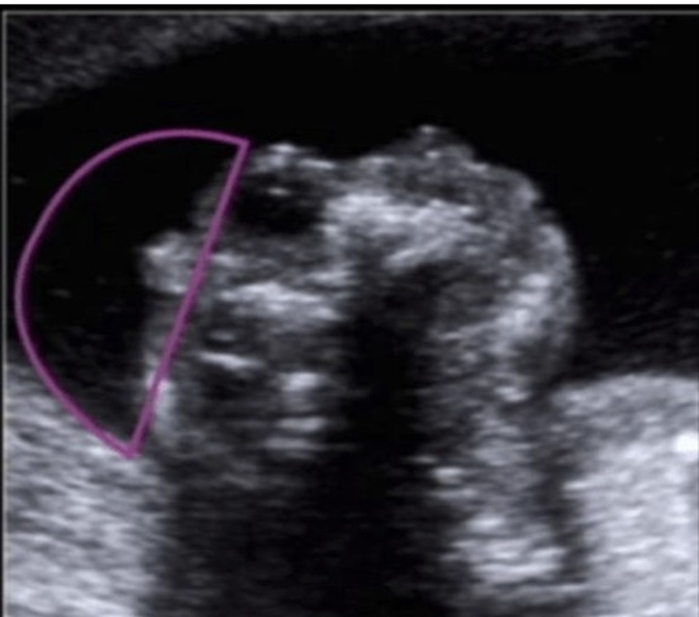 <p>Absent cranial vault</p><p>Absent/incomplete forebrain</p><p>Presence of brain stem, midbrain, skull base, face - has stromal covering</p><p>Bulging eyes</p><p>Lethal</p>