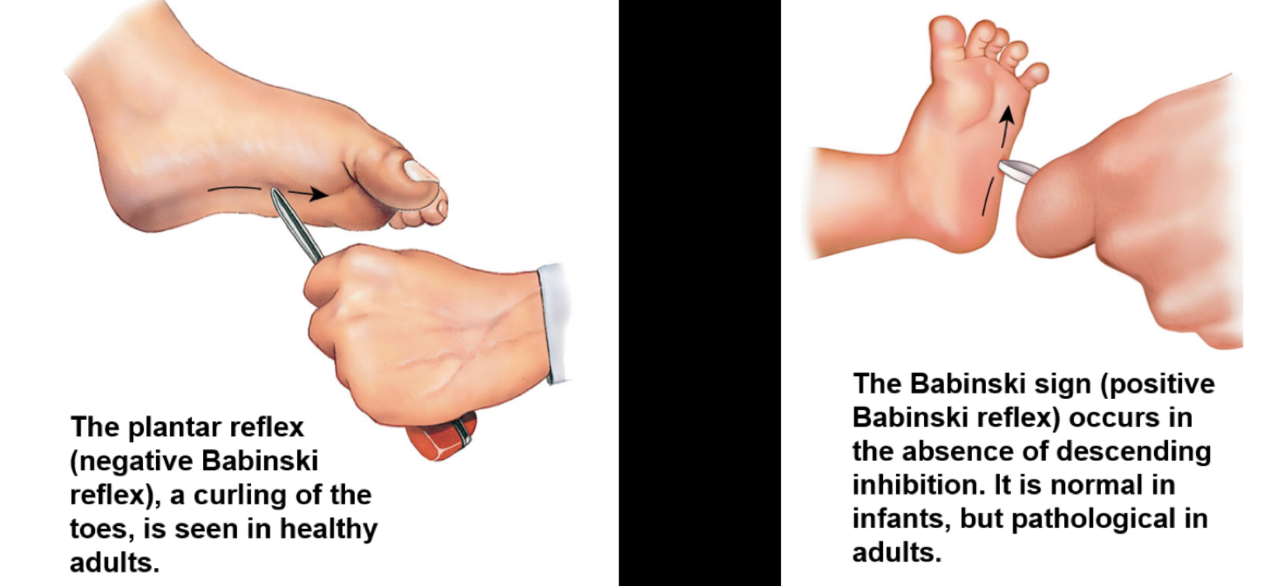 <p>(Pathological test) </p><ul><li><p>the curling of toes is healthy (flexor response)</p></li><li><p>A baby doesn’t curl their toes due to them not walking yet (up to age 1)</p><ul><li><p>Also called extensor response</p></li></ul></li><li><p>if an adult extends toes, something is not right with upper motor neuron </p><ul><li><p>Very few ppl have paradoxical extensor response or no response at all</p></li></ul></li></ul>