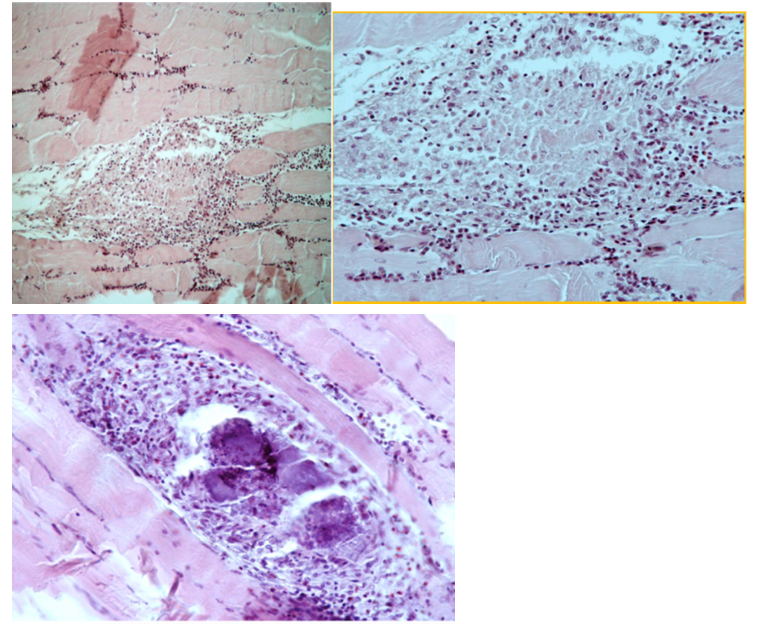 <p>Myositis sarcosporidica</p>