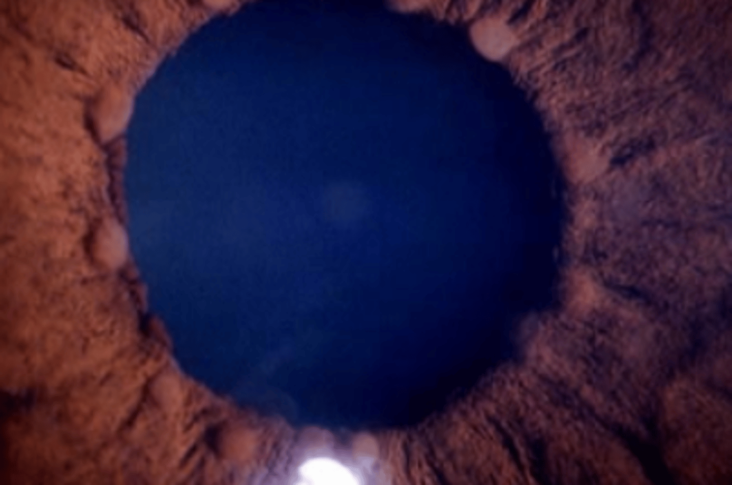 <p>inflammatory nodules of the iris stroma located at the pupil border. Can occur with any form of ocular inflammation, granulomatous or non-granulomatous.</p>