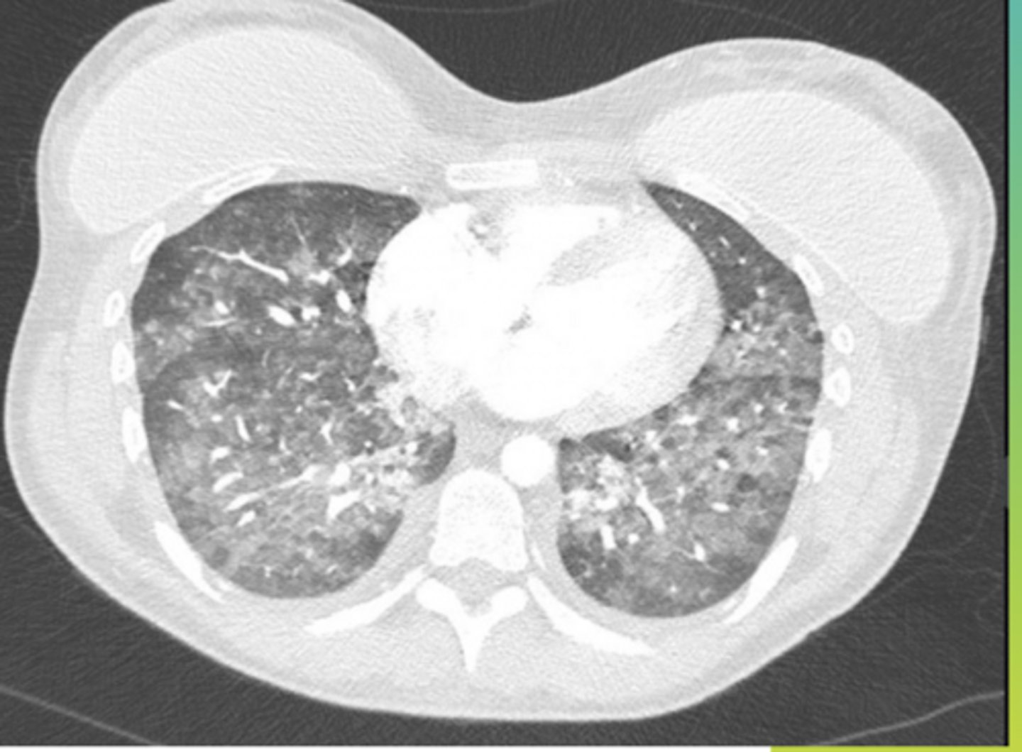 <p>Name the condition</p>