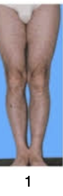 <p><span>Which angular deformity does this patient have?</span></p><p></p>